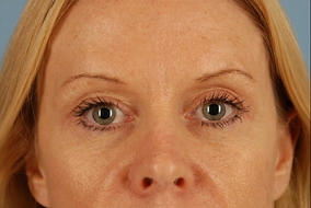 Brow Lift Before & After Image