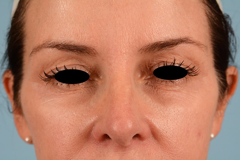 Brow Lift Before & After Image