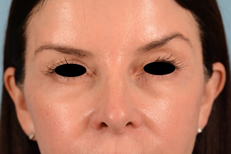 Brow Lift Before & After Image