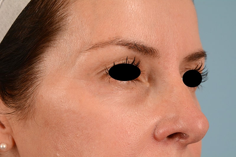 Brow Lift Before & After Image