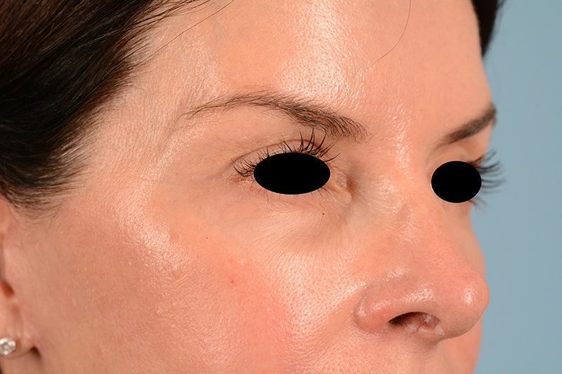 Brow Lift Before & After Image