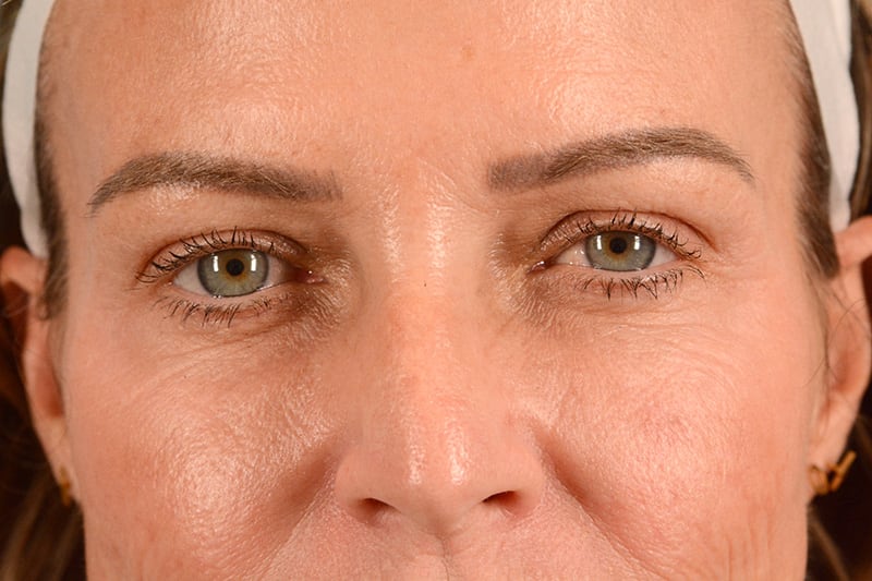 Brow Lift Before & After Image
