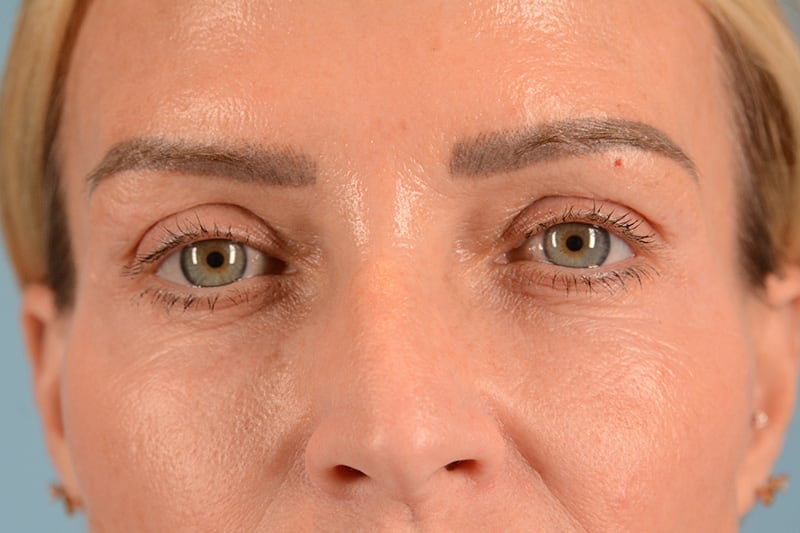 Brow Lift Before & After Image