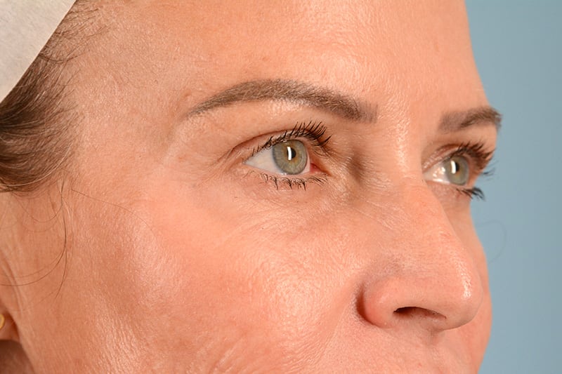 Brow Lift Before & After Image
