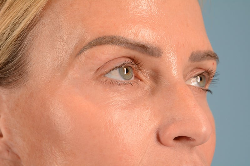 Brow Lift Before & After Image