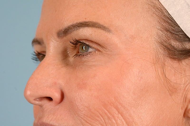 Brow Lift Before & After Image