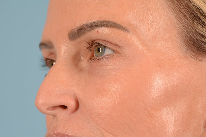 Brow Lift Before & After Image