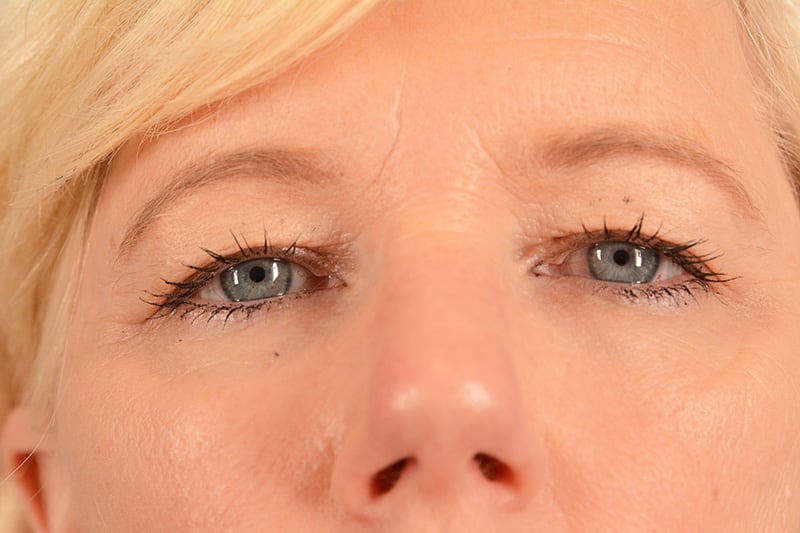 Brow Lift Before & After Image