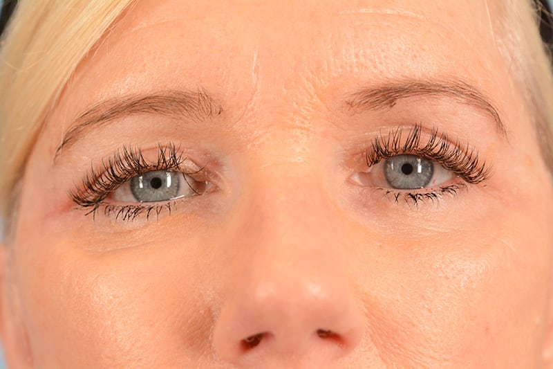 Brow Lift Before & After Image