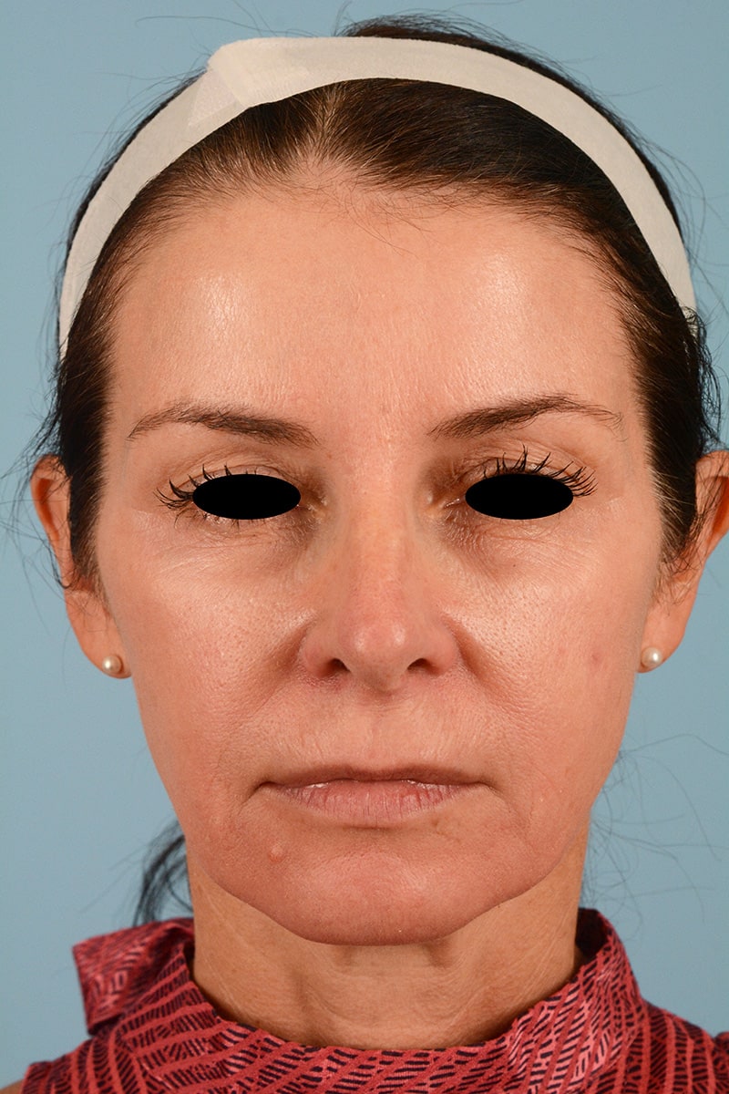 Chin Implant Before & After Image