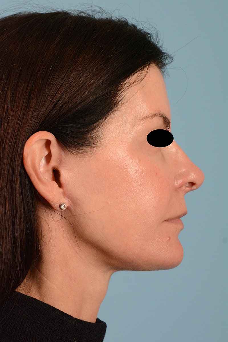 Chin Implant Before & After Image