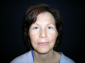 Facelift Before & After Image