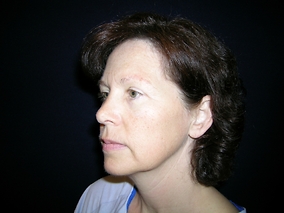 Facelift Before & After Image