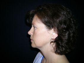 Facelift Before & After Image