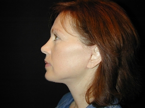 Facelift Before & After Image