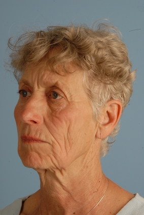 Facelift Before & After Image