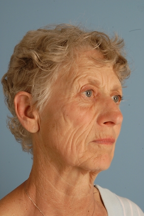 Facelift Before & After Image