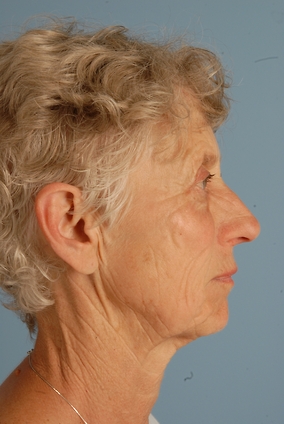 Facelift Before & After Image