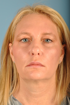 Facelift Before & After Image