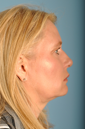 Facelift Before & After Image