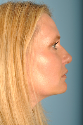 Facelift Before & After Image