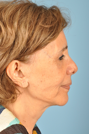 Facelift Before & After Image