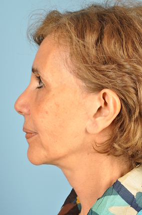 Facelift Before & After Image