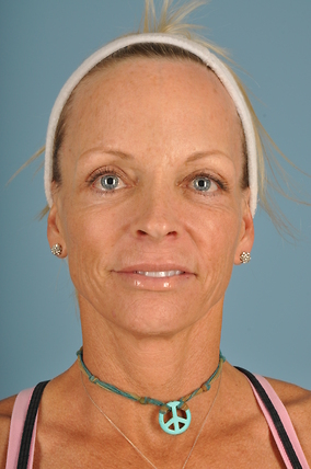 Facelift Before & After Image