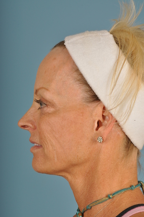 Facelift Before & After Image