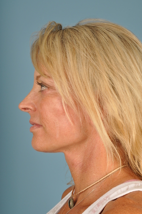 Facelift Before & After Image