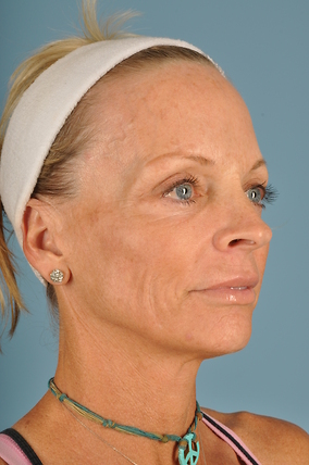 Facelift Before & After Image