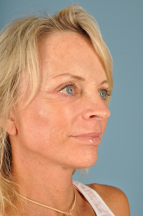 Facelift Before & After Image