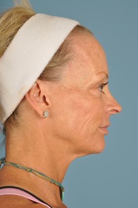 Facelift Before & After Image