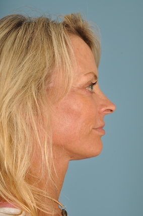 Facelift Before & After Image