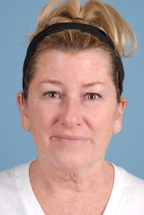 Facelift Before & After Image