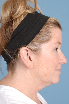 Facelift Before & After Image