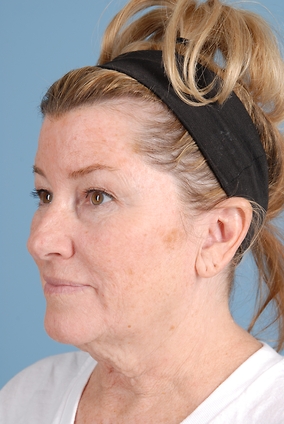 Facelift Before & After Image