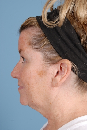 Facelift Before & After Image