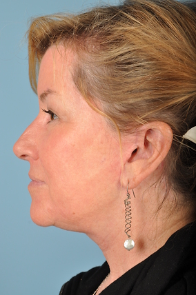 Facelift Before & After Image