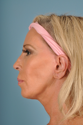 Facelift Before & After Image