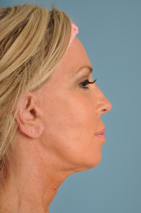 Facelift Before & After Image