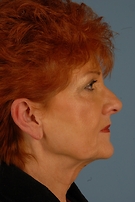 Facelift Before & After Image