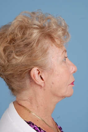 Facelift Before & After Image