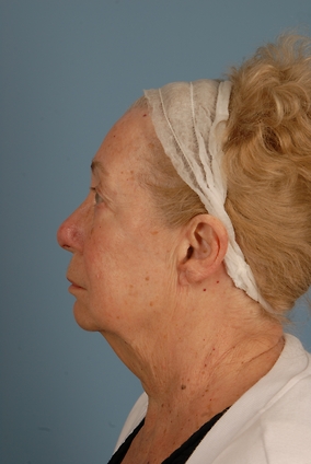 Facelift Before & After Image