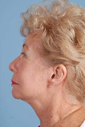 Facelift Before & After Image