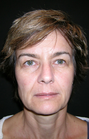 Facelift Before & After Image