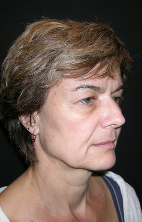 Facelift Before & After Image