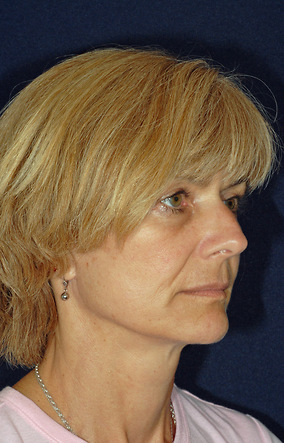 Facelift Before & After Image