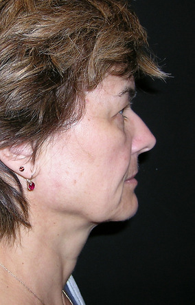 Facelift Before & After Image