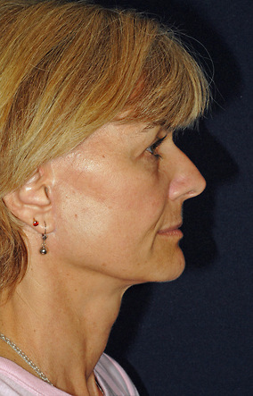 Facelift Before & After Image